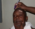 rombo-cataract-before-surgery